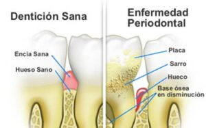 Clínica Dental Manuel Marín - Enfermedad periodontal