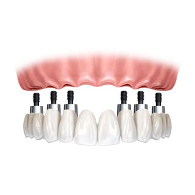 Clínica Dental Manuel Marín - Implantología