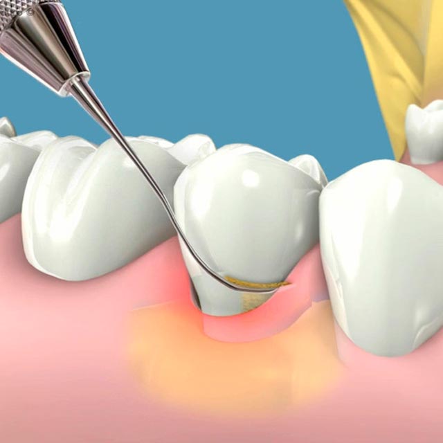 Clínica Dental Manuel Marín - Periodoncia
