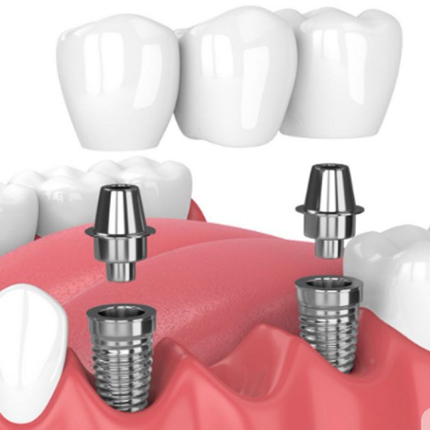 Clínica Dental Manuel Marín - Implantología